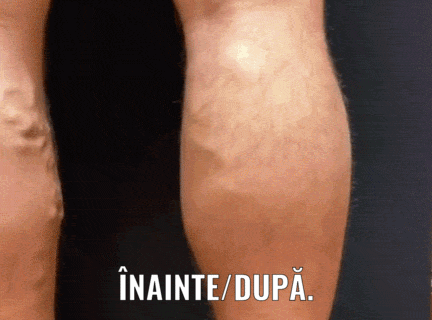 Cremă Pentru Vene Varicoase
